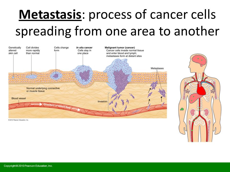 Metastasis muscular
